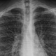 Chest radiograph of a 17-year-old male taken two days after he was admitted to hospital, showing signs of “popcorn lung.”